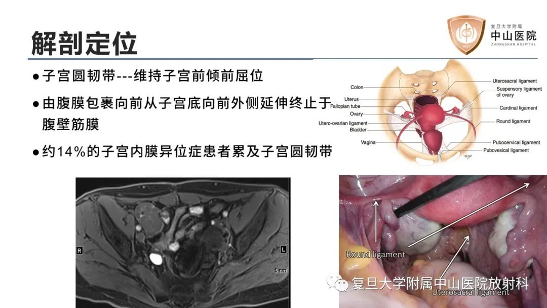 【病例】子宫腺肌瘤1例MR影像-10