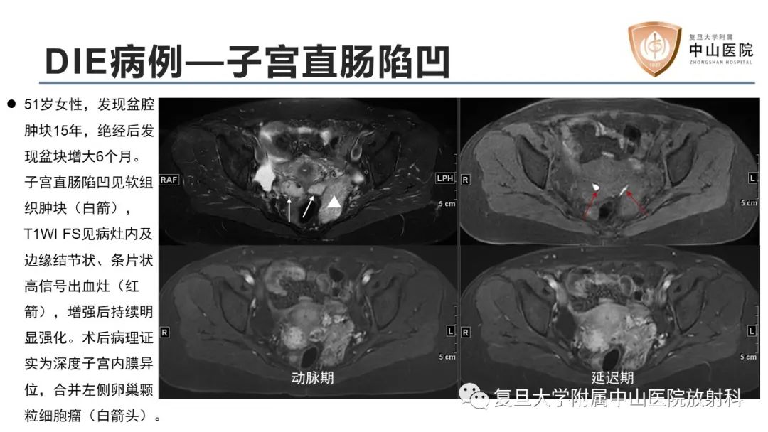 【病例】子宫腺肌瘤1例MR影像-13