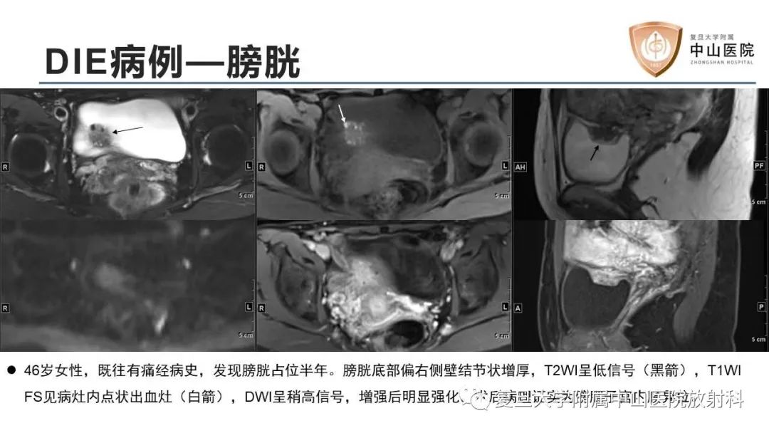 【病例】子宫腺肌瘤1例MR影像-14