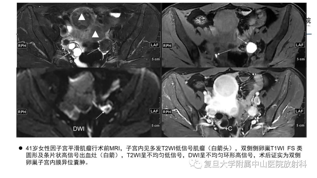 【病例】子宫腺肌瘤1例MR影像-16