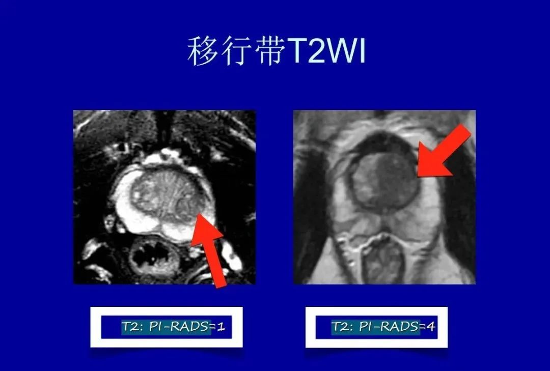 【PPT】前列腺癌MRI诊断再认识-5