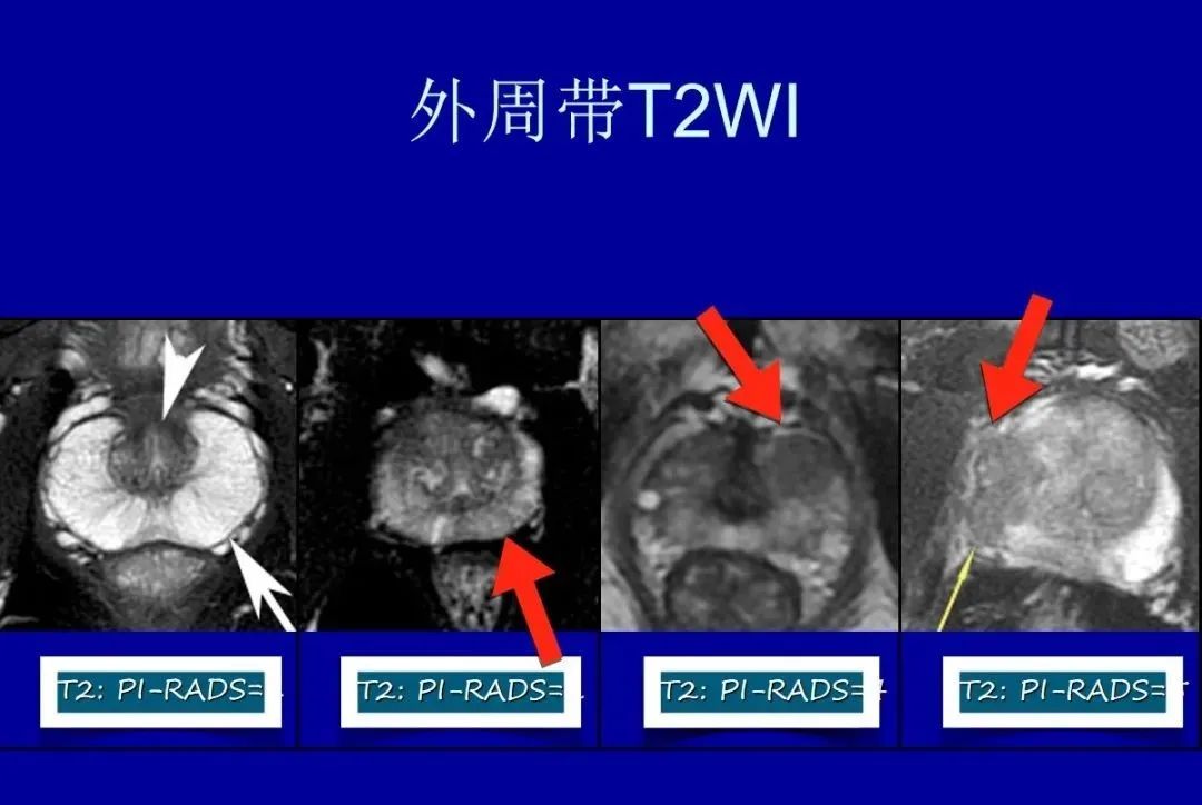 【PPT】前列腺癌MRI诊断再认识-7