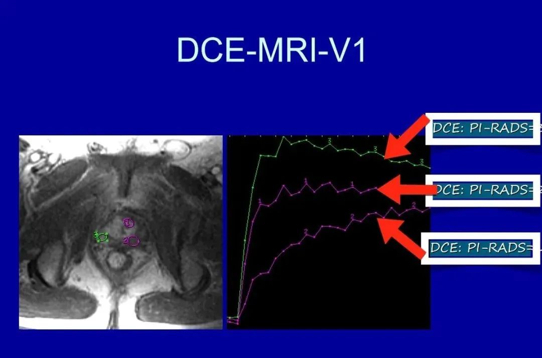 【PPT】前列腺癌MRI诊断再认识-10