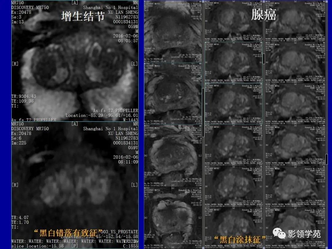 【PPT】前列腺癌MRI诊断再认识-12
