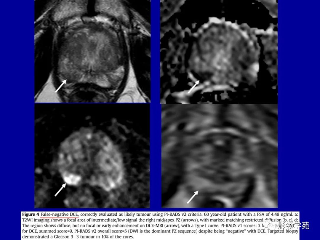 【PPT】前列腺癌MRI诊断再认识-19
