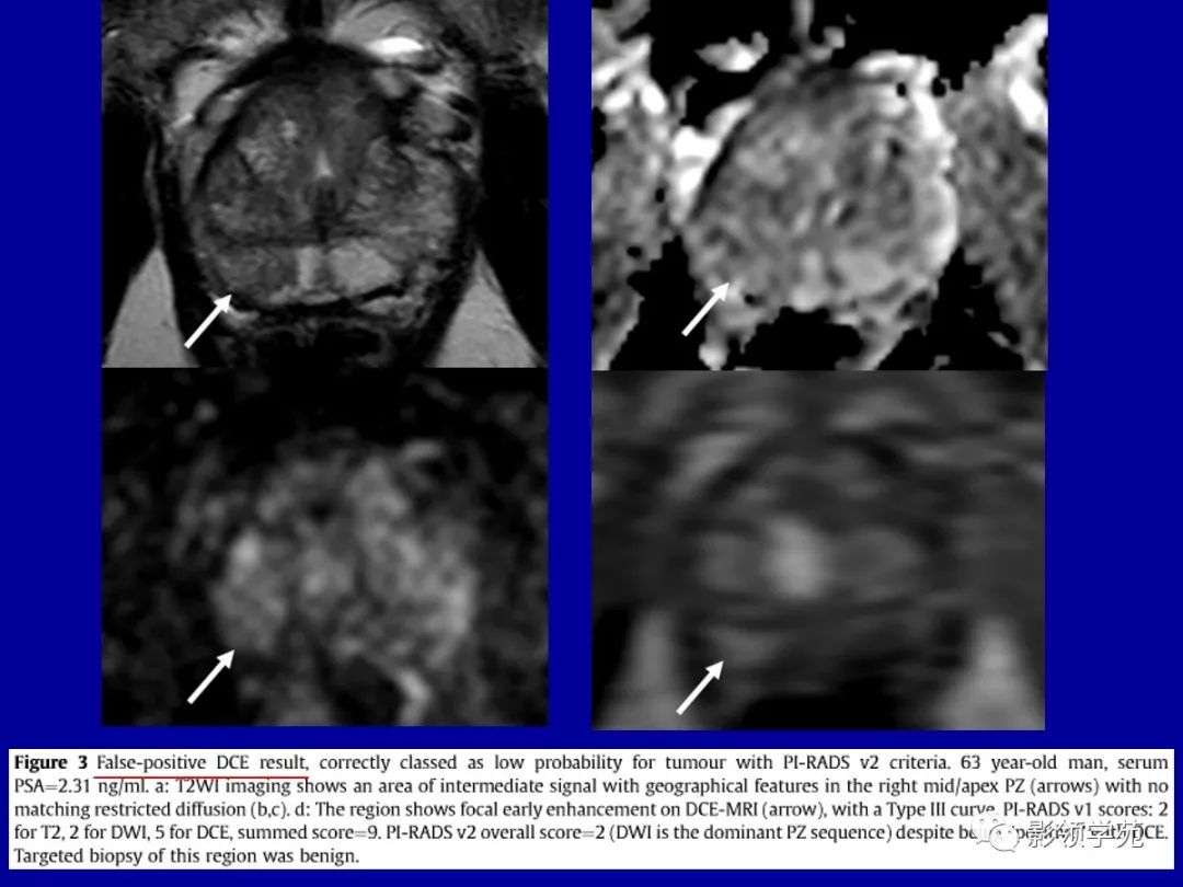 【PPT】前列腺癌MRI诊断再认识-18