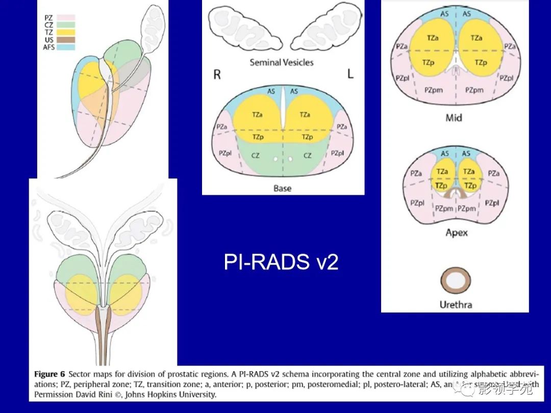 【PPT】前列腺癌MRI诊断再认识-25