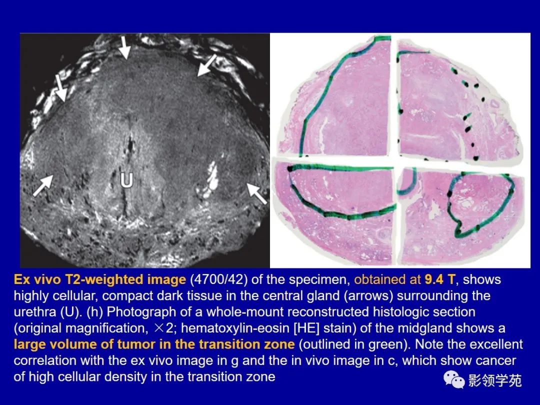 【PPT】前列腺癌MRI诊断再认识-29