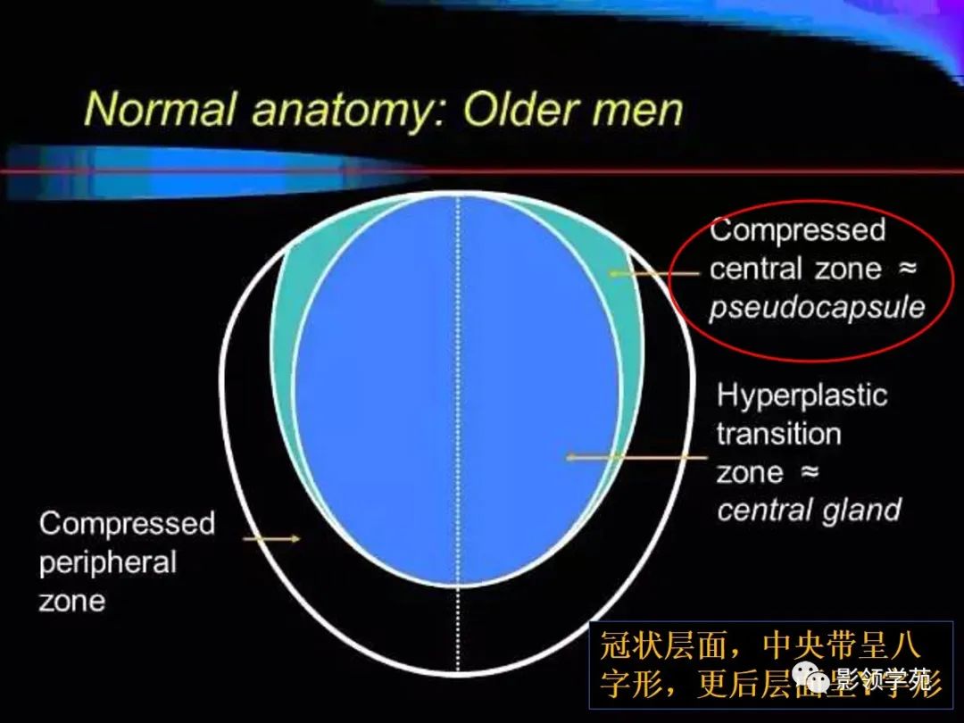 【PPT】前列腺癌MRI诊断再认识-37
