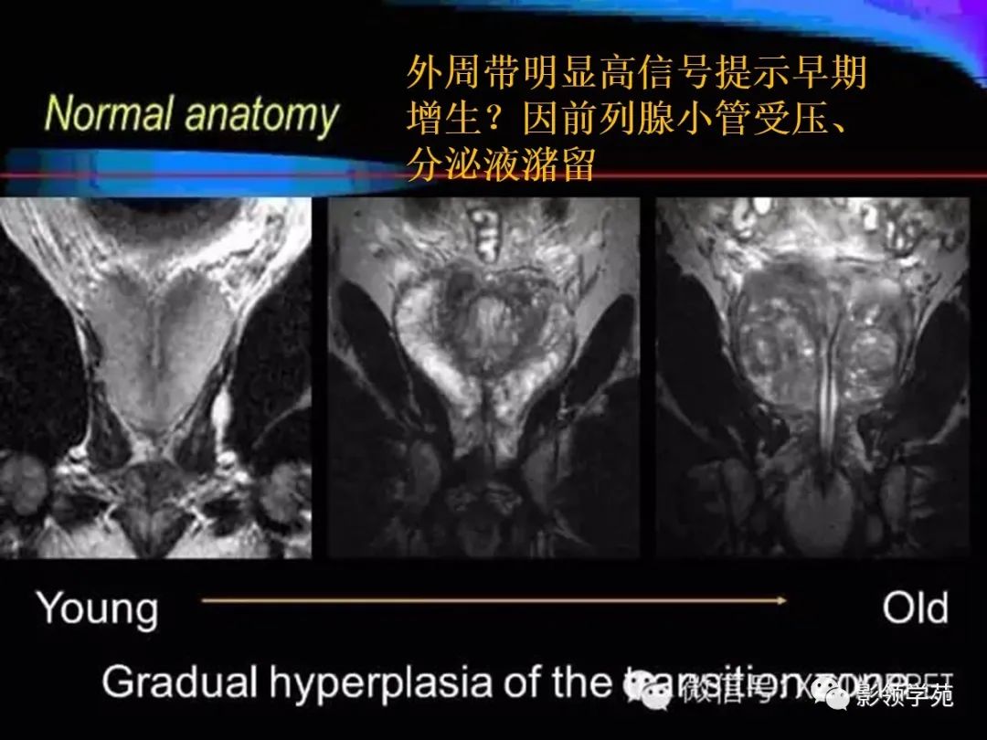 【PPT】前列腺癌MRI诊断再认识-38