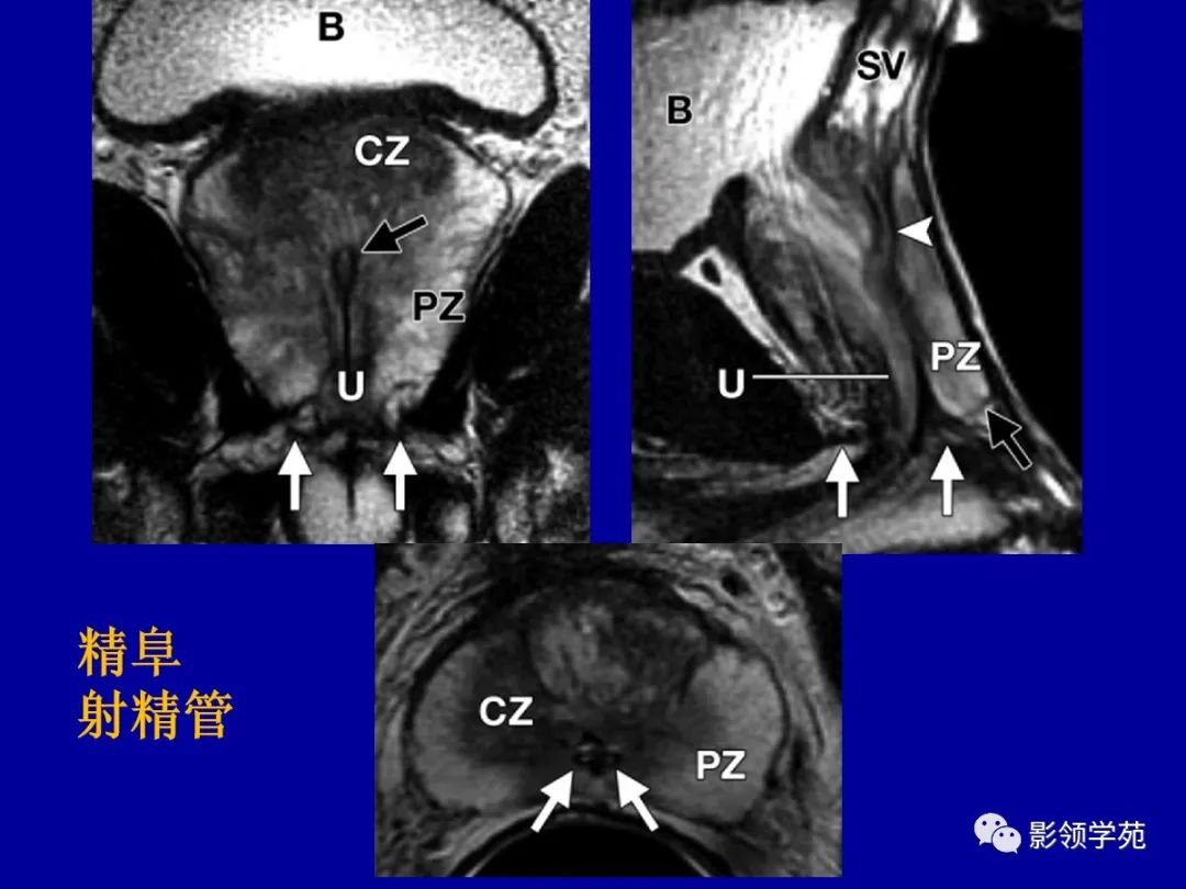 【PPT】前列腺癌MRI诊断再认识-39