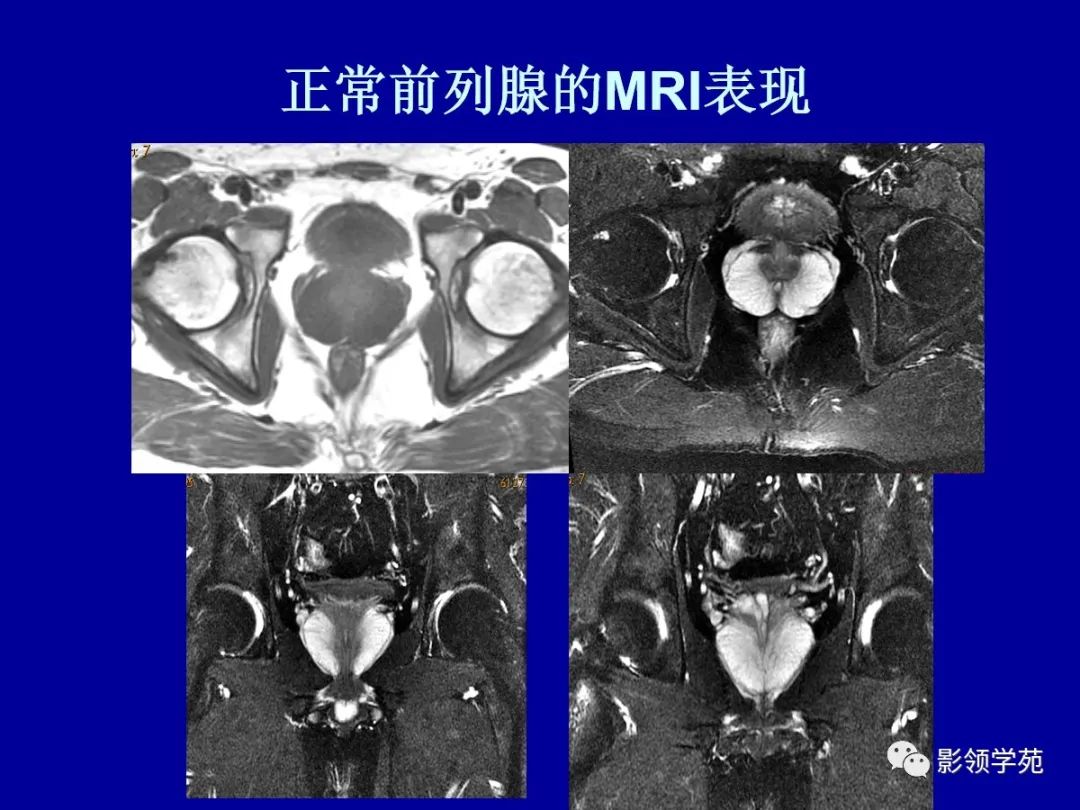 【PPT】前列腺癌MRI诊断再认识-47