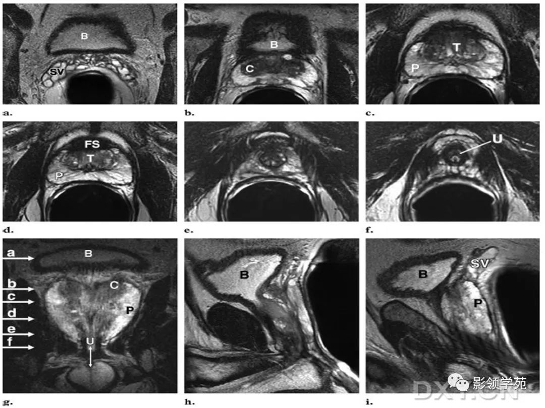 【PPT】前列腺癌MRI诊断再认识-48
