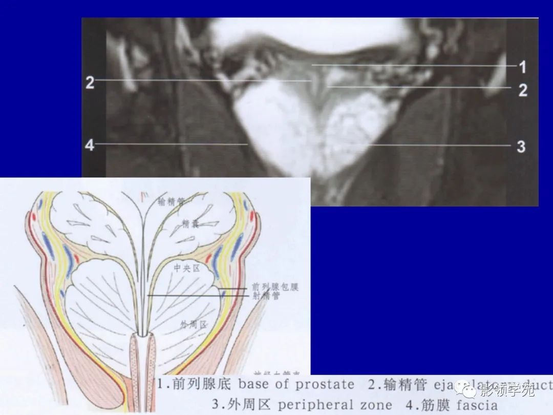 【PPT】前列腺癌MRI诊断再认识-49
