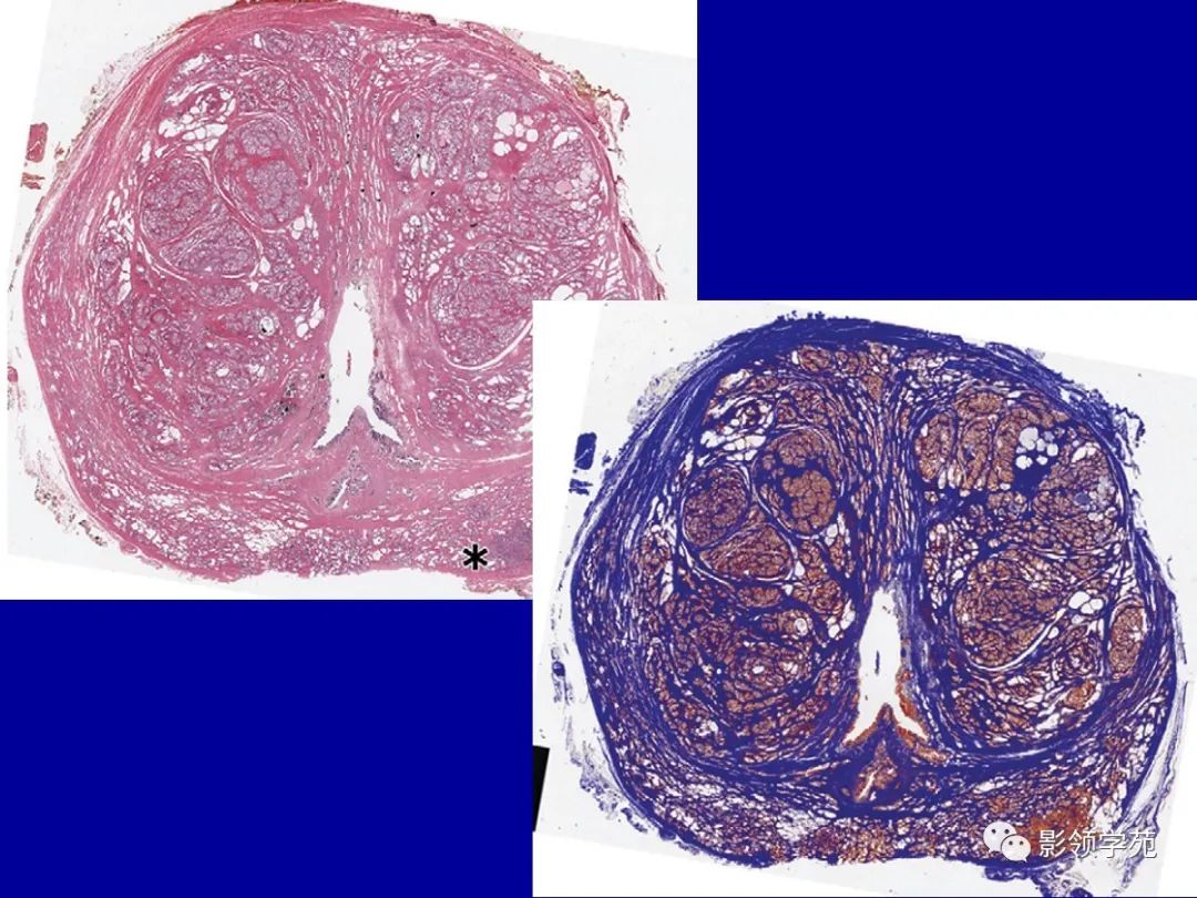 【PPT】前列腺癌MRI诊断再认识-51