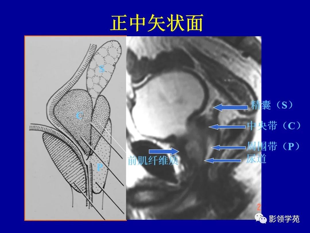 【PPT】前列腺癌MRI诊断再认识-53