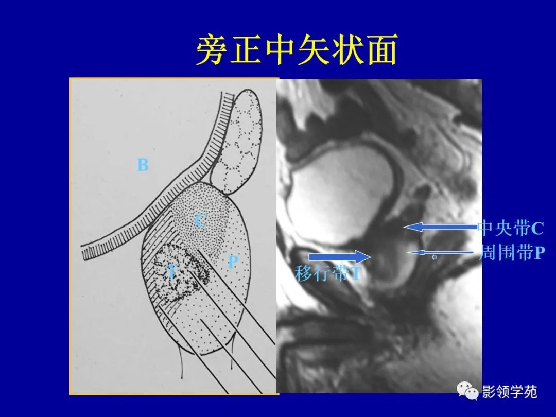 【PPT】前列腺癌MRI诊断再认识-54