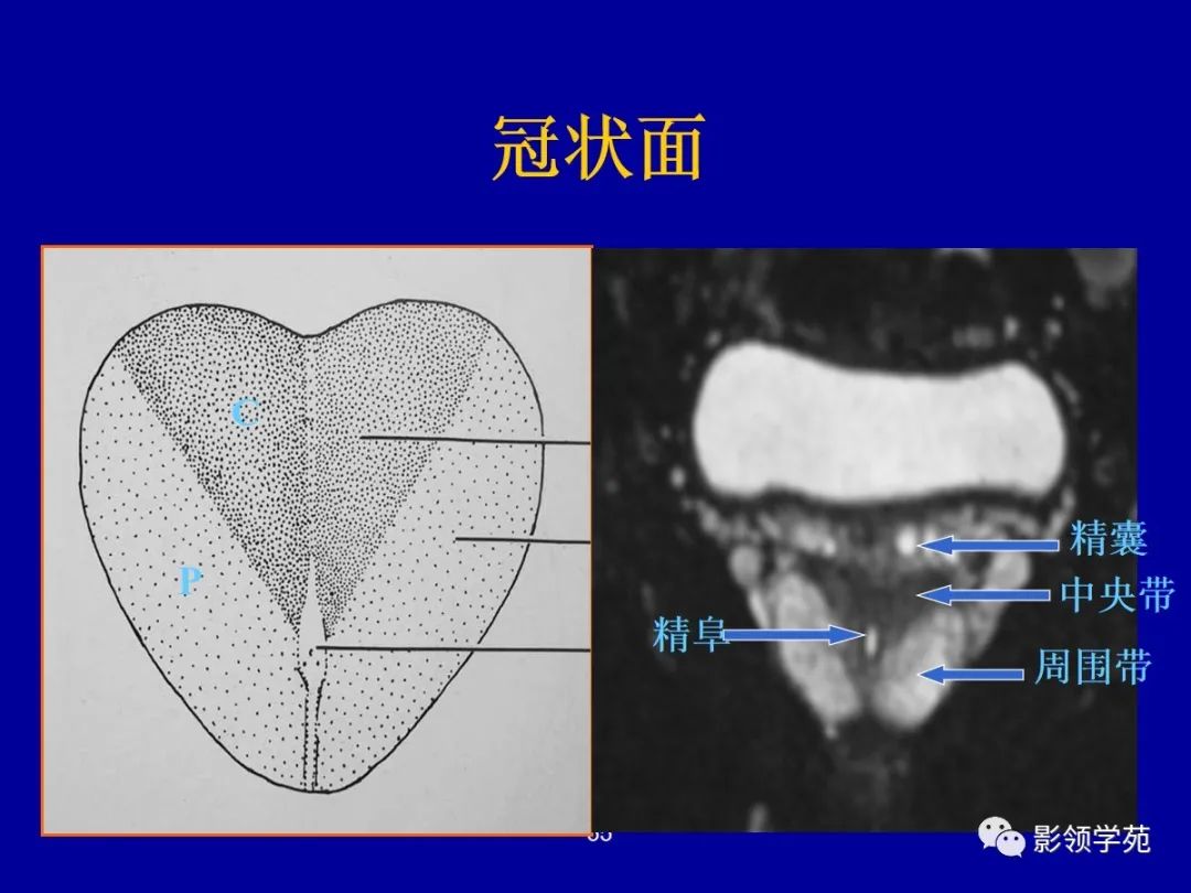 【PPT】前列腺癌MRI诊断再认识-55
