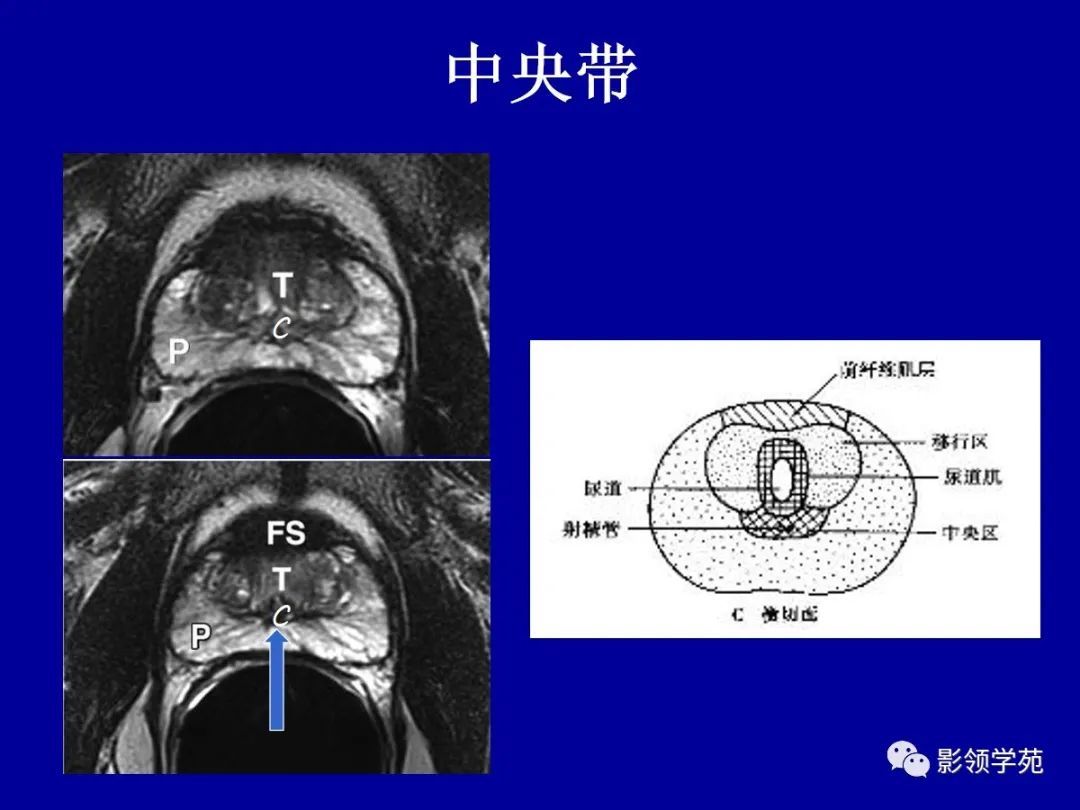 【PPT】前列腺癌MRI诊断再认识-56