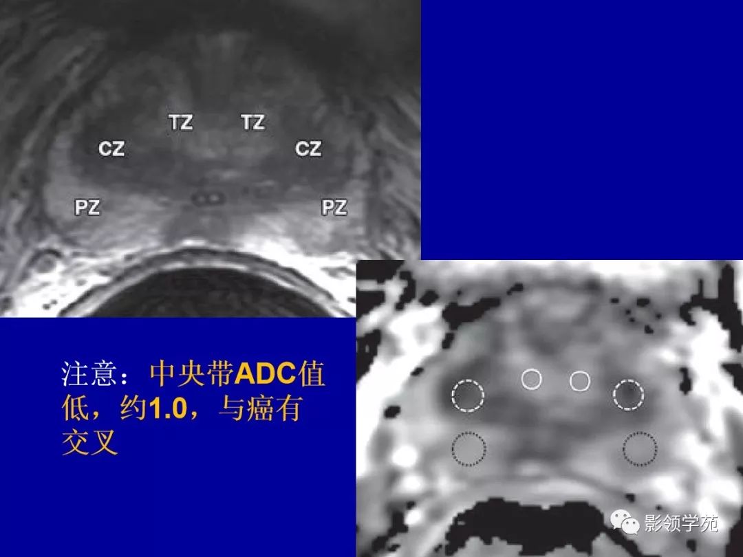 【PPT】前列腺癌MRI诊断再认识-57