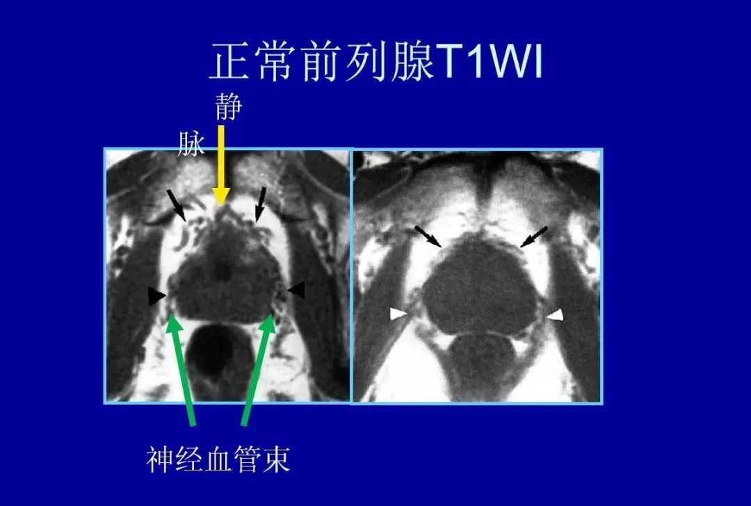 【PPT】前列腺癌MRI诊断再认识-58