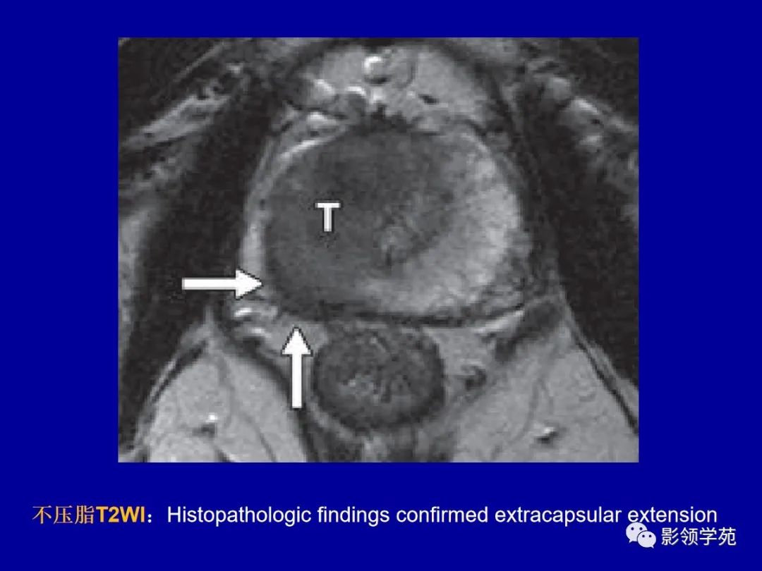 【PPT】前列腺癌MRI诊断再认识-62