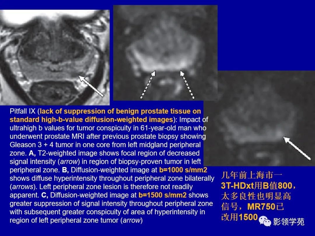 【PPT】前列腺癌MRI诊断再认识-64