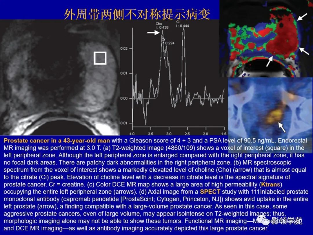 【PPT】前列腺癌MRI诊断再认识-71