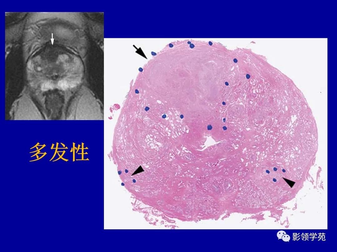 【PPT】前列腺癌MRI诊断再认识-72