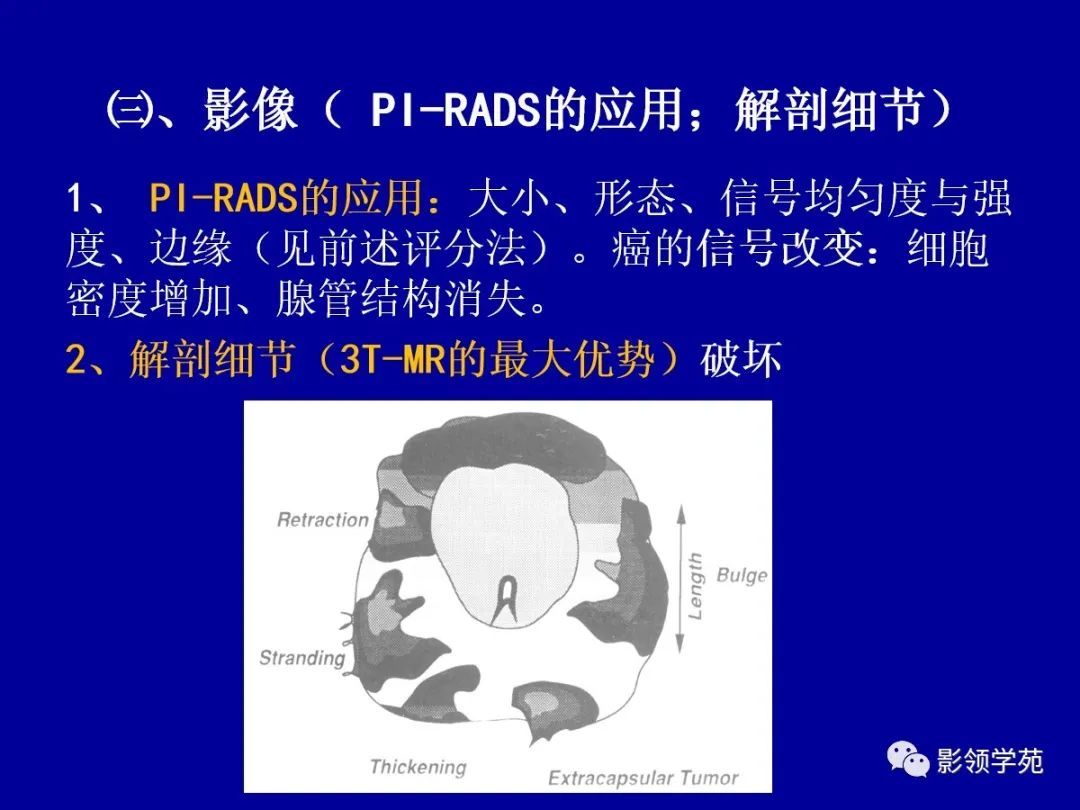 【PPT】前列腺癌MRI诊断再认识-73