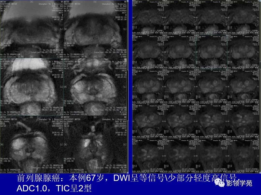 【PPT】前列腺癌MRI诊断再认识-75