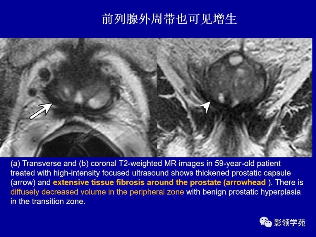 【PPT】前列腺癌MRI诊断再认识-76
