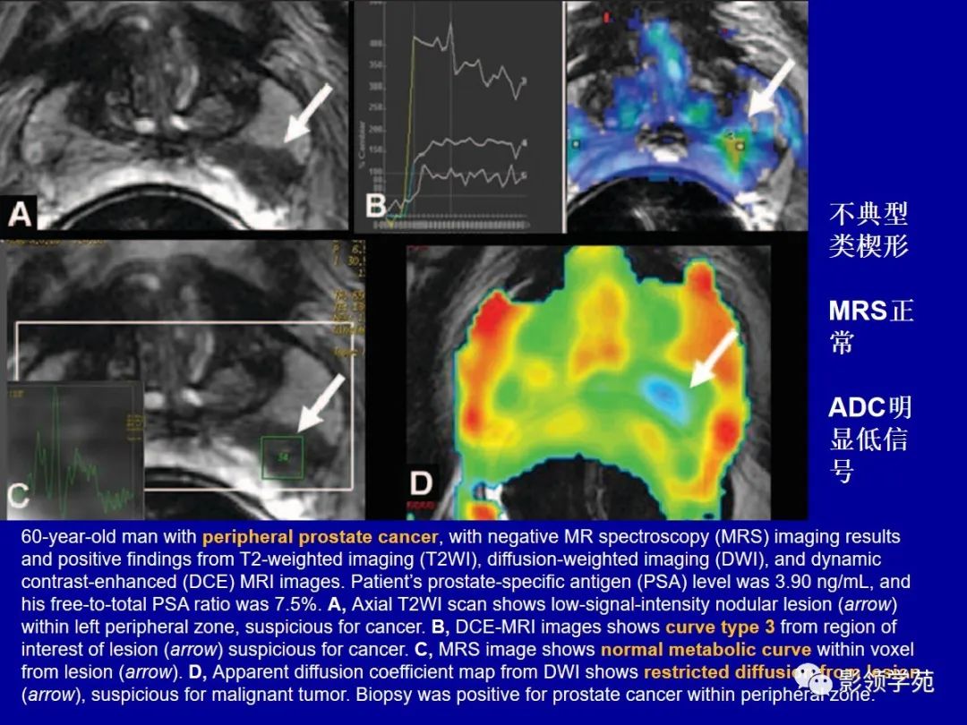 【PPT】前列腺癌MRI诊断再认识-77