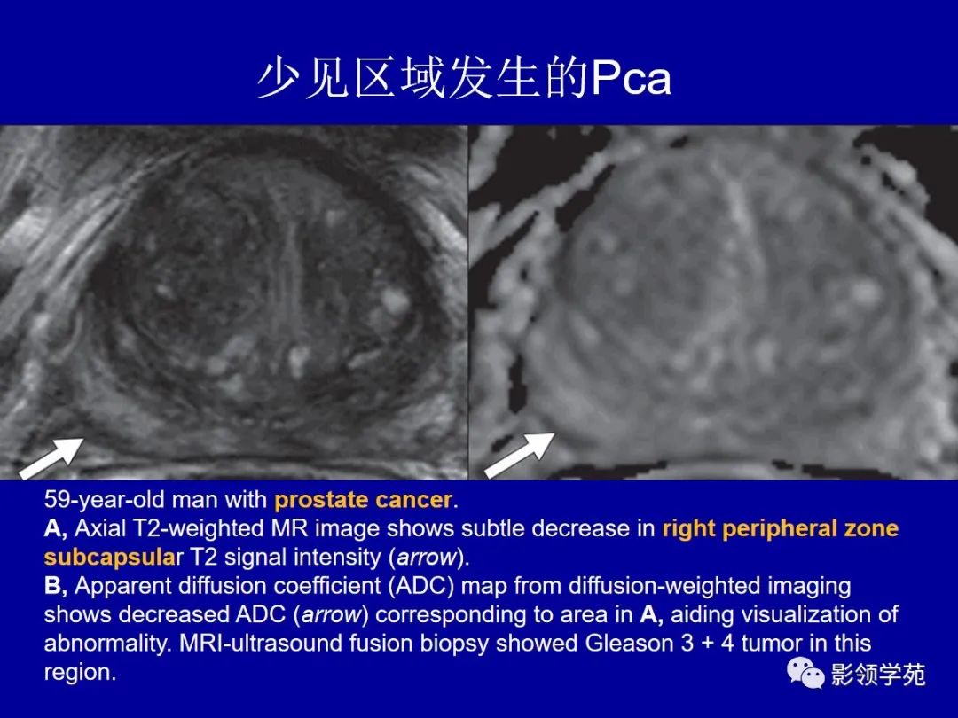 【PPT】前列腺癌MRI诊断再认识-78