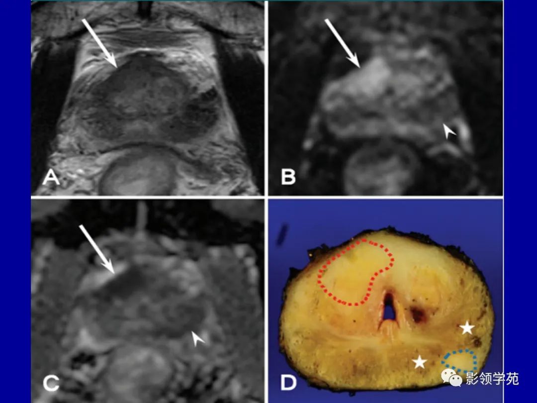 【PPT】前列腺癌MRI诊断再认识-80