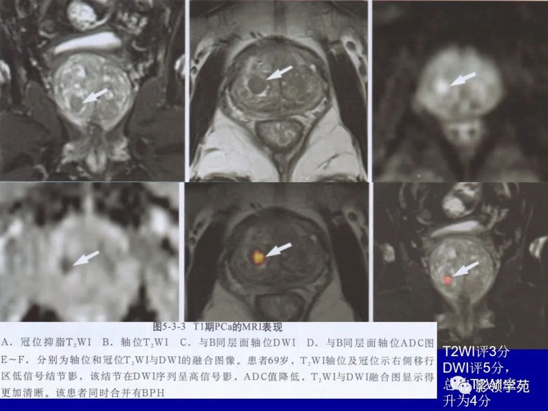 【PPT】前列腺癌MRI诊断再认识-84