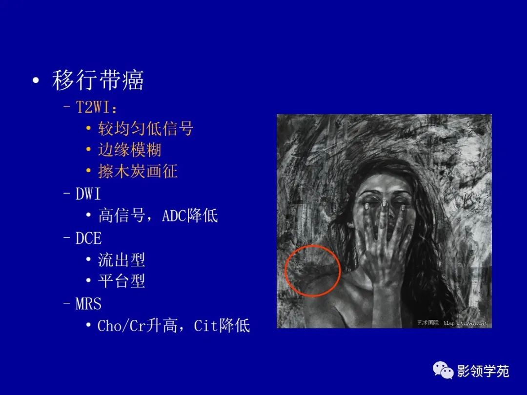 【PPT】前列腺癌MRI诊断再认识-85