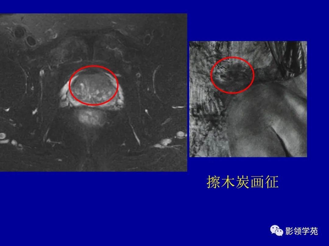 【PPT】前列腺癌MRI诊断再认识-86