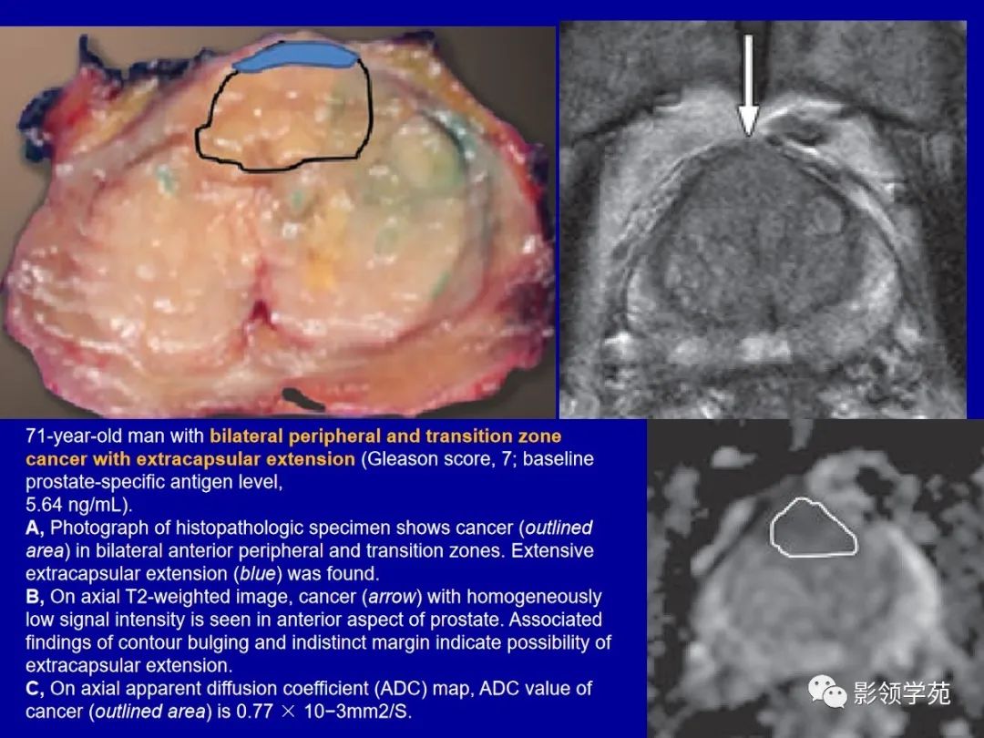 【PPT】前列腺癌MRI诊断再认识-89