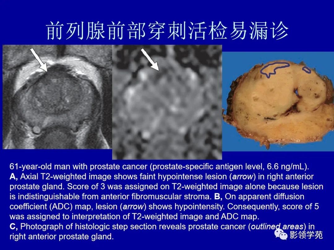【PPT】前列腺癌MRI诊断再认识-87