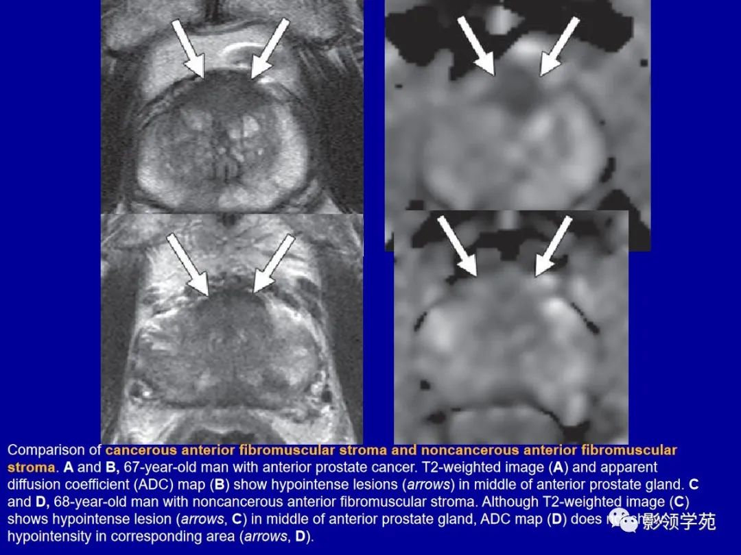 【PPT】前列腺癌MRI诊断再认识-88