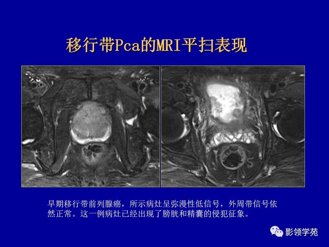 【PPT】前列腺癌MRI诊断再认识-91