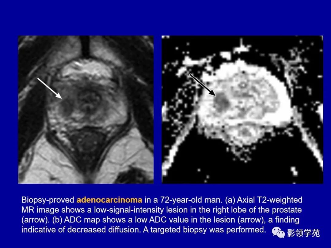【PPT】前列腺癌MRI诊断再认识-92