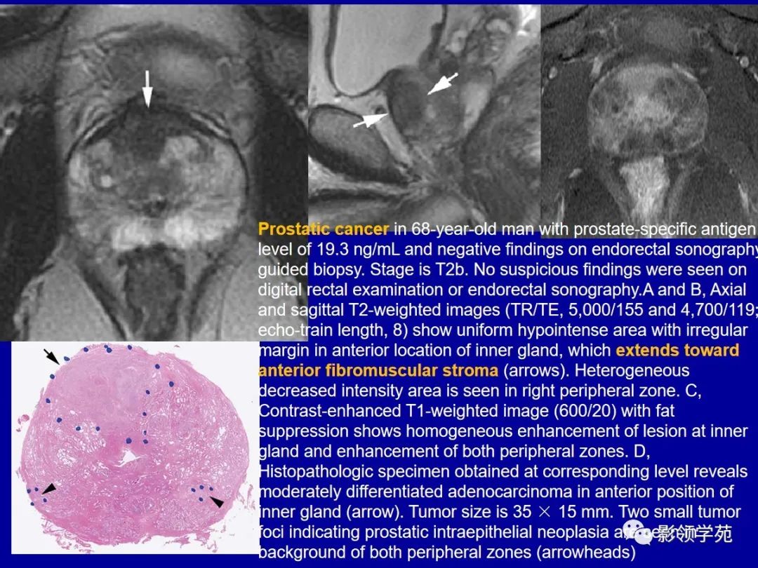 【PPT】前列腺癌MRI诊断再认识-93