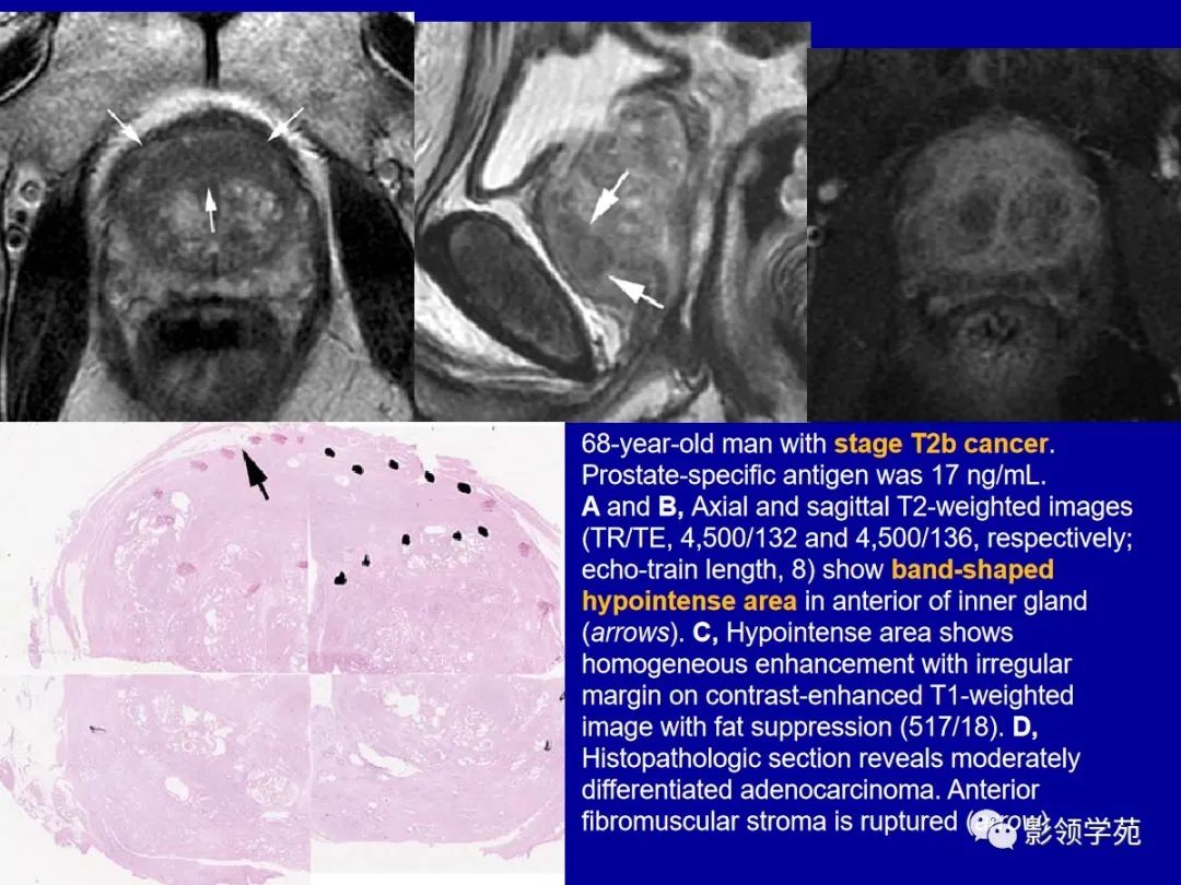 【PPT】前列腺癌MRI诊断再认识-95