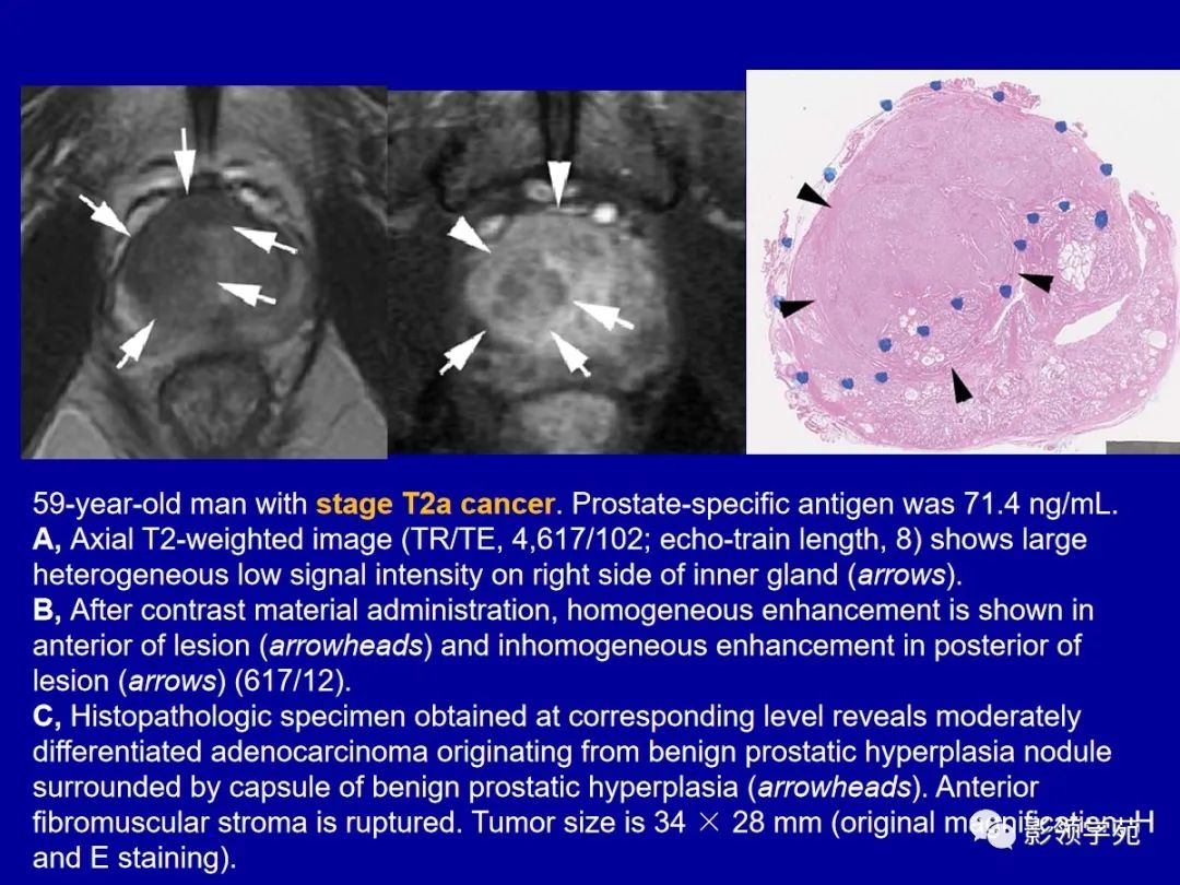 【PPT】前列腺癌MRI诊断再认识-96