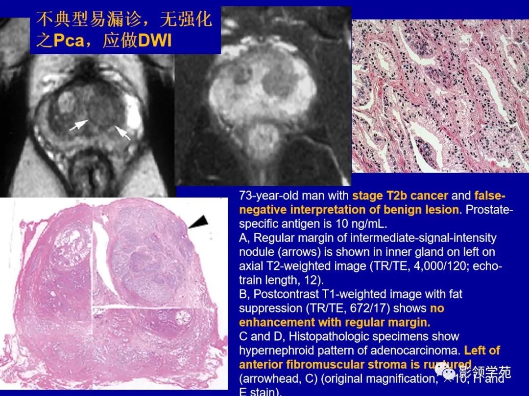 【PPT】前列腺癌MRI诊断再认识-97