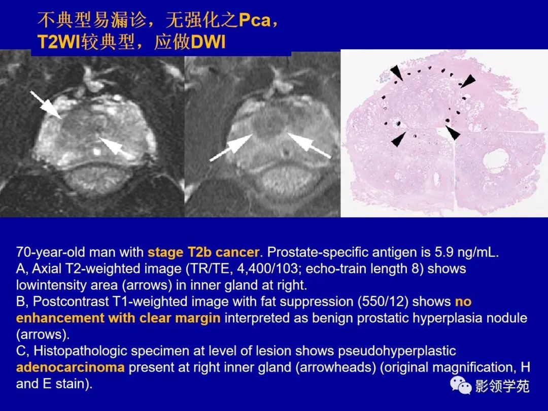 【PPT】前列腺癌MRI诊断再认识-98