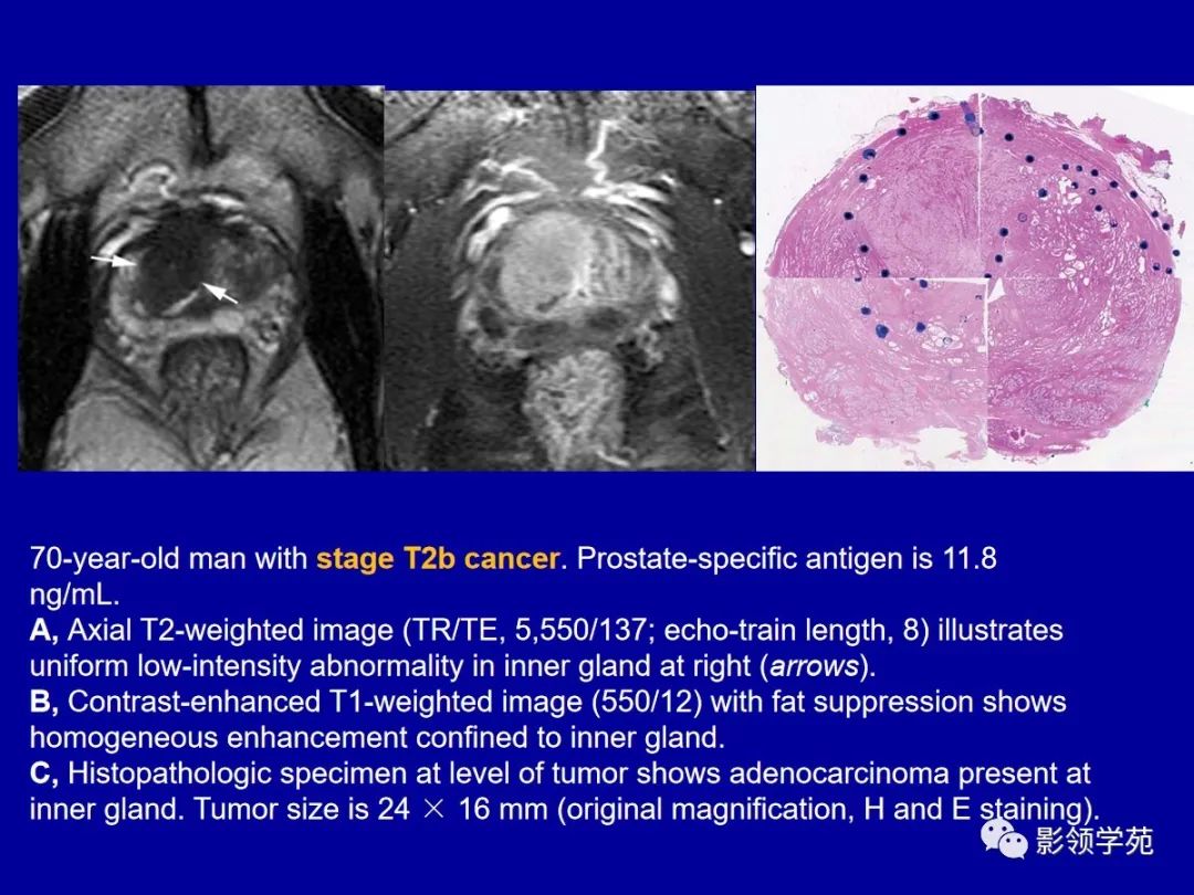 【PPT】前列腺癌MRI诊断再认识-94