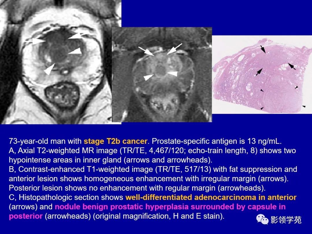 【PPT】前列腺癌MRI诊断再认识-99